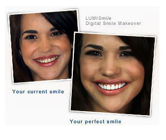 How do you get a digital smile makeover from Lumineers?